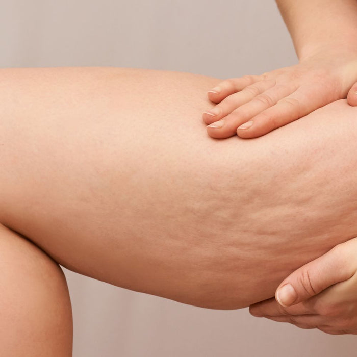 Are Compression Boots Good for Cellulite?