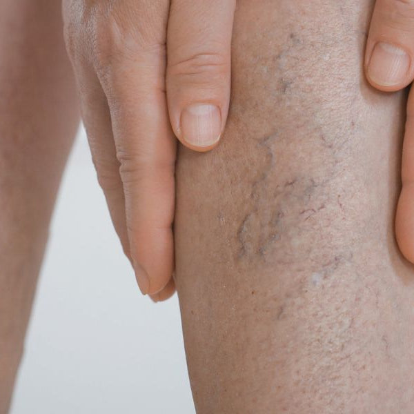 Are Compression Boots Good for Varicose Veins?
