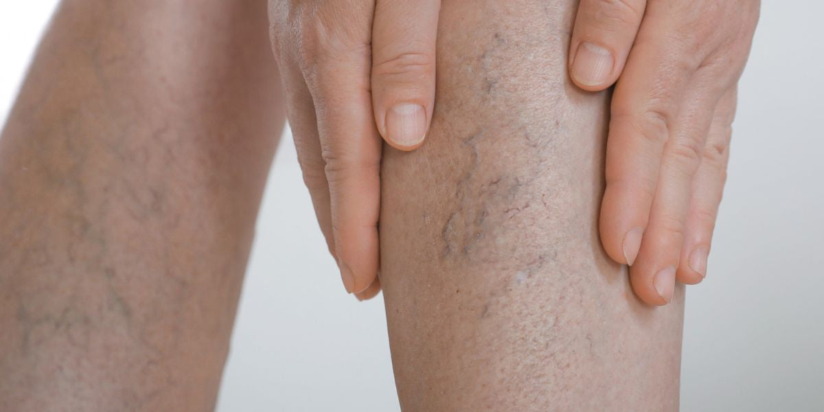 Are Compression Boots Good for Varicose Veins? — Proactive Recovery