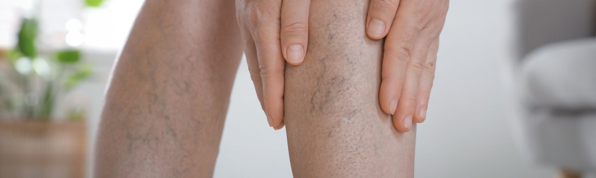 Are Compression Boots Good for Varicose Veins? — Proactive Recovery